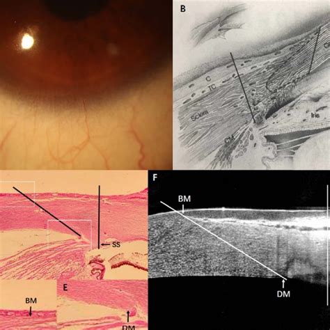 outline   limbus   examinations  limbus