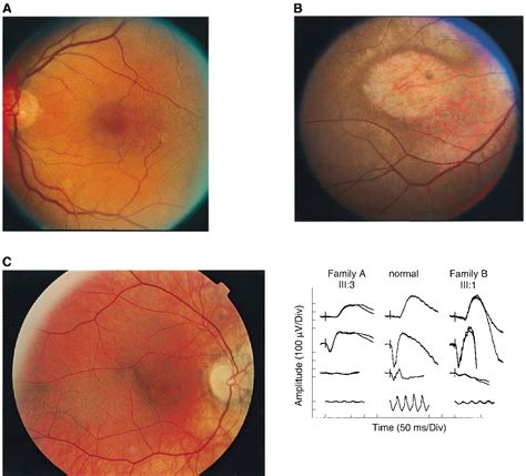 Pdf Mutations In The Rpgr Gene Cause X Linked Cone Dystrophy