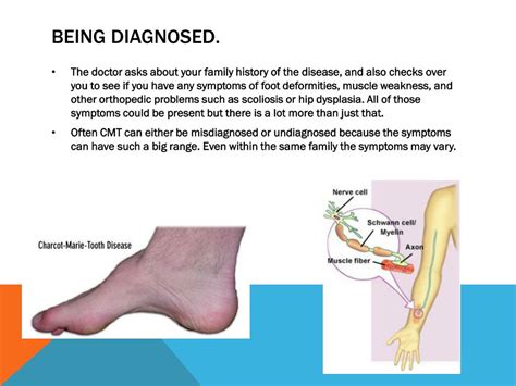 PPT - Charcot Marie Tooth Disease PowerPoint Presentation, free ...