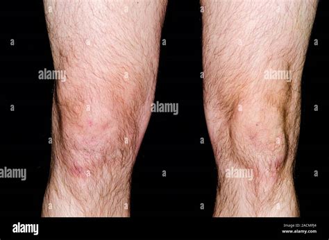 Rodilla hinchada con derrame líquido de la articulación a la