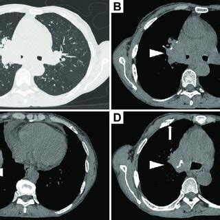 Follow Up Plain Chest Computed Tomography CT Indicated Local