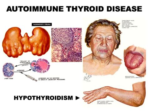 Autoimmune Thyroid Diseases