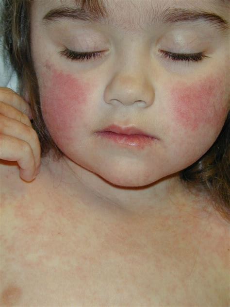 HEALTHCARESMV: HEALTH - SKIN RASH