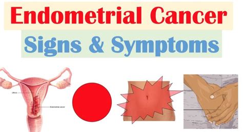 Endometrial Cancer Diagnosis And Treatment