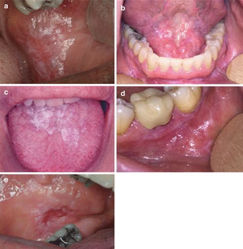 Common Lesions In Oral Pathology For The General Dentist Springerlink