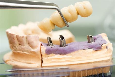 Replace Your Missing Teeth With A Dental Bridge Luvic Advanced