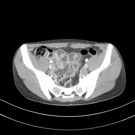 File Abdominal Multi Trauma Devascularised Kidney And Liver Spleen