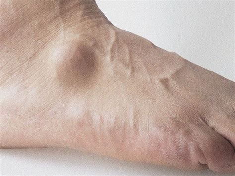 Lump In Vein On Bottom Of Foot Hotsell Emergencydentistry