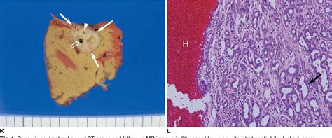 Figure 1 From Imaging Findings Of Intrahepatic Bile Duct Adenoma