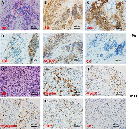 Hematoxylin And Eosin He And Immunohistochemical Stainings In A