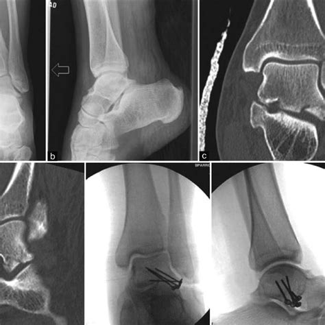 A And B Anteroposterior And Lateral Radiographs Of Ankle Joint