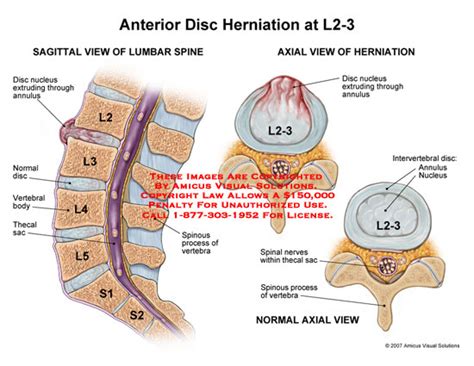 Anterior Disc Herniation At L2 3