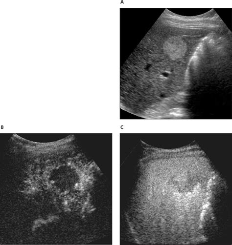 Diagnosis Of Focal Liver Masses On Ultrasonography Wilson 2007 Journal Of Ultrasound In