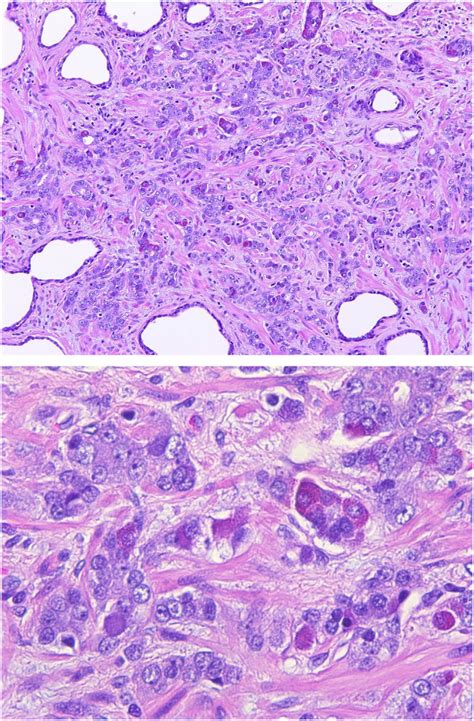 Prostatic Adenocarcinoma With Paneth Cell Like Differentiation Contains Download Scientific