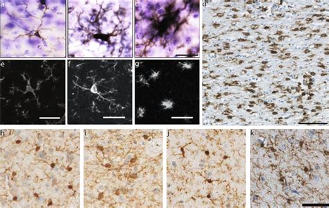 Microglial Phenotypes In Post Mortem Tbi Immunochemistry The Pattern