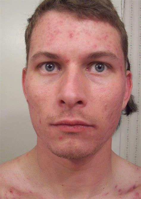 Weekly Accutane Picture Log---Front Face: o_15_weeks_accutane_front_face