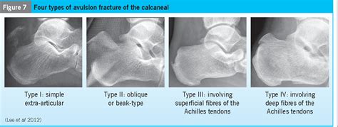 figure   avulsion fracture   calcaneal tuberosity diagnosis