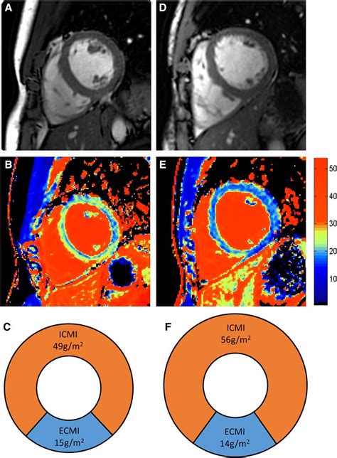 Typical Cardiac Magnetic Resonance Cmr Appearances In Low Performance