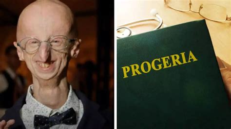 Longest Living Survivor Of Progeria Dies At 28 What Is This Rare