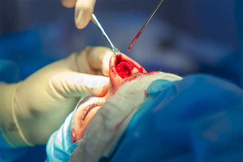 Surgeon And His Assistant Performing Cosmetic Surgery On Nose In