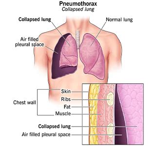 How to fix a Collapsed Lung (pneumothorax)?
