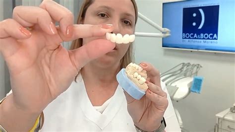 Cu L Es La Diferencia Entre Corona Y Carilla Dental Cl Nicas