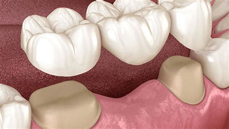 Dental Bridges Vs Partial Dentures Pros Cons Smiles Toothache