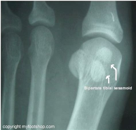 Sesamoid Fractures Causes And Treatment Options