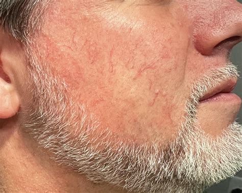 Bbl Treatment After One Treatment Results Surprisingly Effective For