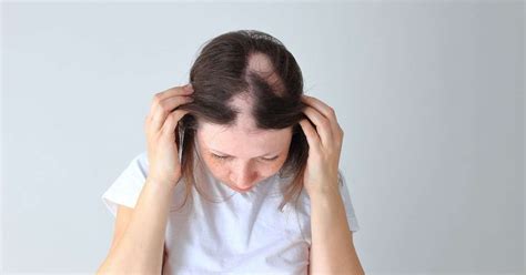 Cabelo Branco E Sinal De Doença - Queda de cabelo pode ser sinal de doença