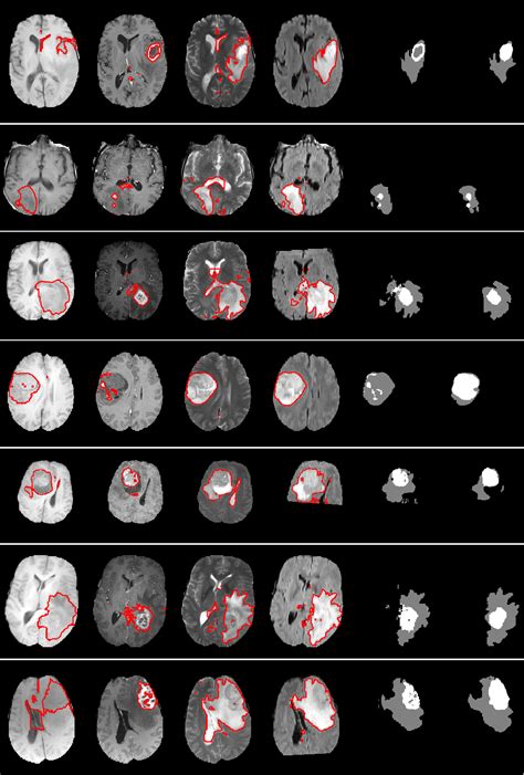 Figure From Multi Modal Brain Tumor Segmentation Via Latent Atlases