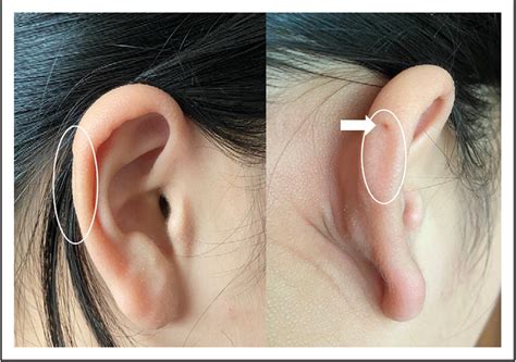 The Differences Between 2 Cases Of Preauricular Fistula Semantic Scholar