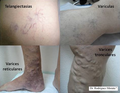 Tratamientos Varices Rodriguezmorata