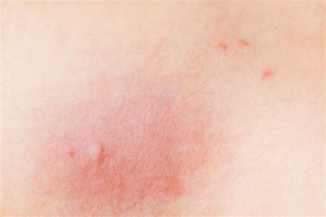 Horsefly bite: How to tell if you've been bitten - what do horsefly ...