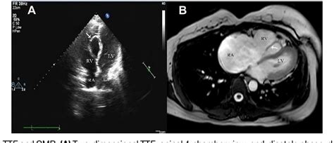 Figure From Interventricular Septal Hematoma Following Correction Of