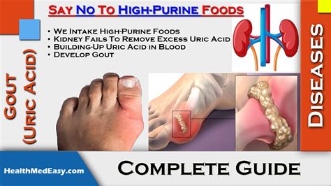 Gout Uric Acid Symptoms Treatments Side Effects Healthmedeasy