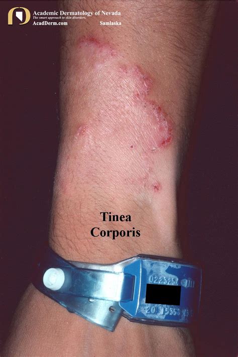 Tinea Corporis Ringworm Tinea Circinata Academic Dermatology Of