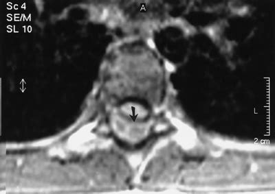 Spinal Epidural Abscess - Spine - Orthobullets