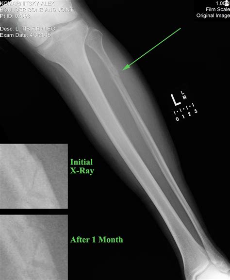 Stress Fracture Fibula X Ray