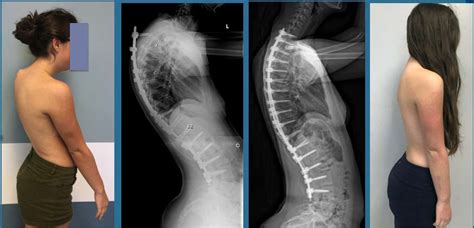 Masters Surgical Technique Operative Treatment Of Scheuermanns