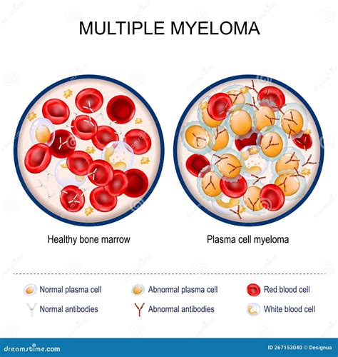 Multiple Myeloma Close Up Of Healthy Bone Marrow And Plasma Cell