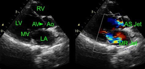 Mitral Regurgitation With Aortic Stenosis Echocardiogram All About