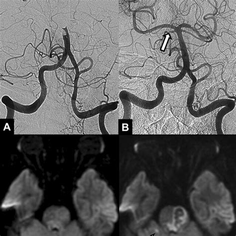 A Year Old Female Patient With Acute Stroke Due To Basilar Artery