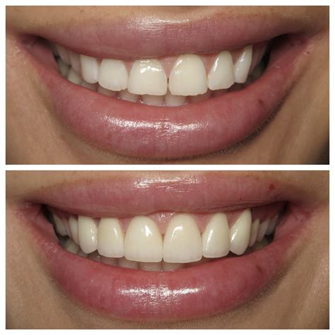 Teeth Scaling And Polishing Treatment In Dubai Sejovi Dental And Implant Center