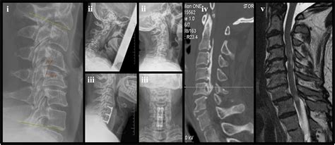 Degenerative Cervical Myelopathy A Practical Approach To Diagnosis