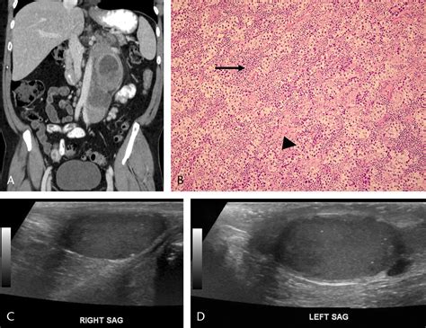 Testicular Microlithiasis In The Setting Of Primary Extragon