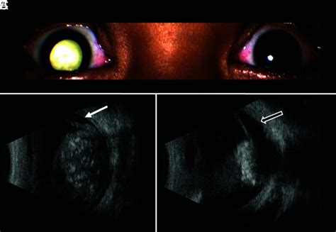 Retinoblastoma What The Neuroradiologist Needs To Know Pmc