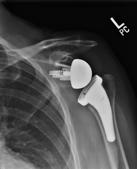 What Is A Reverse Shoulder Replacement Dr Kyle Mcclintock