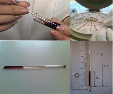 Miyo Spiral Práctica 1 Determinación de Microhematocrito