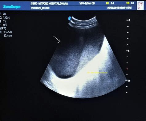 Case 07: Retroperitoneal Hematoma Ultrasound